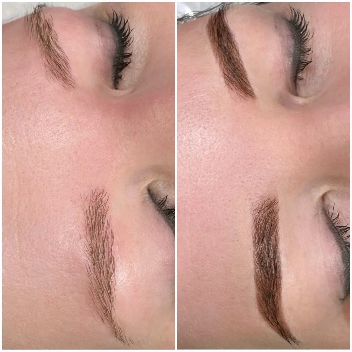 Brow treatment result